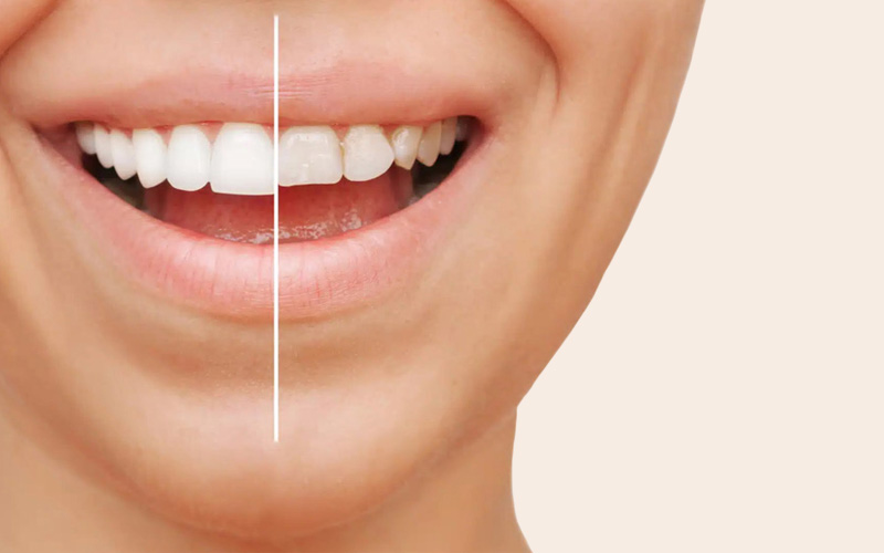 Как бруксизм со временем меняет лицо?