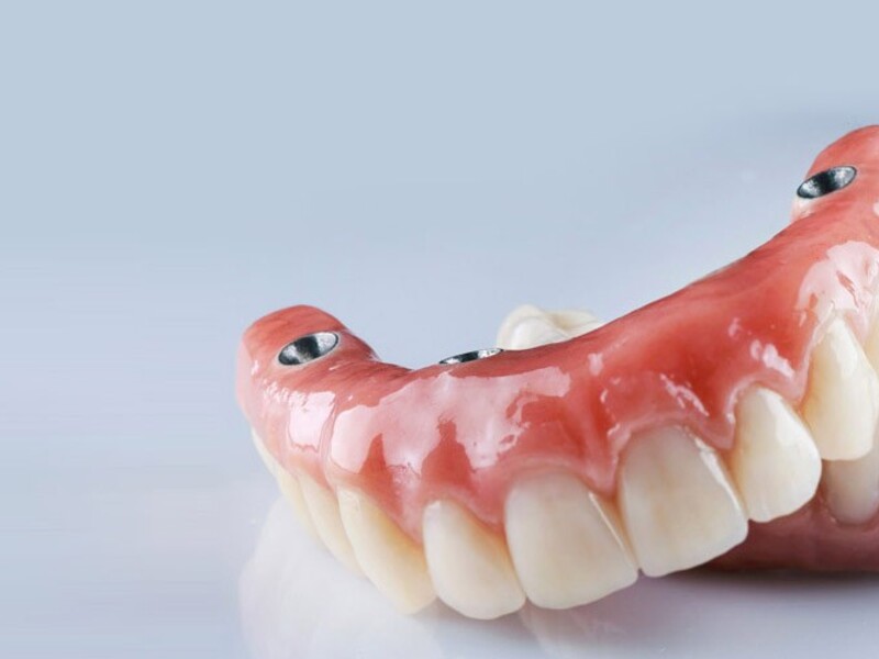 Плюсы и минусы протезирования зубов All-on-4