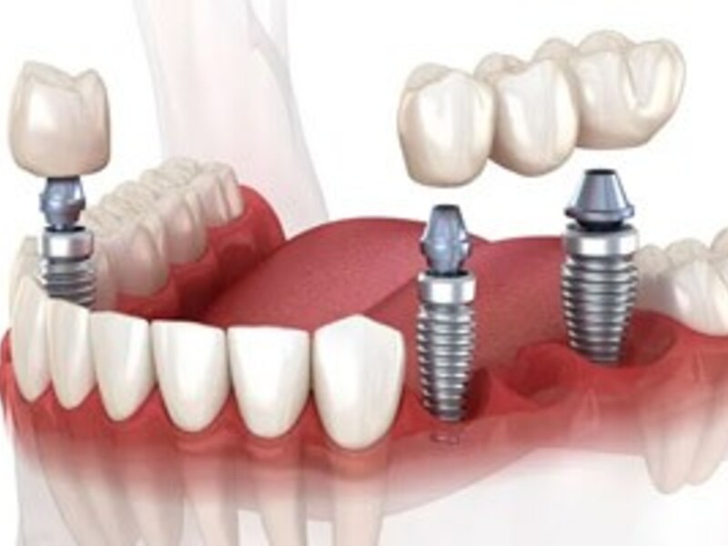 Когда зубные имплантаты являются лучшим вариантом?