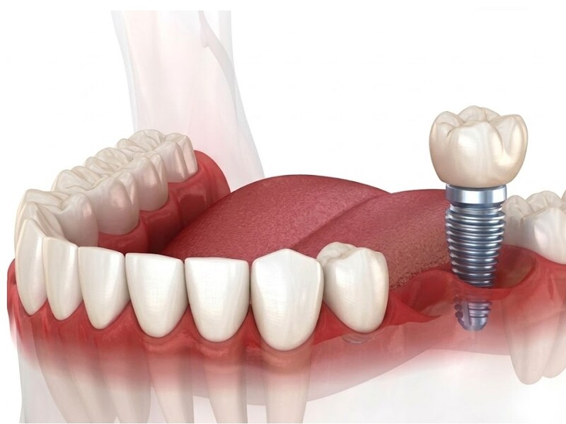 зубные имплантаты