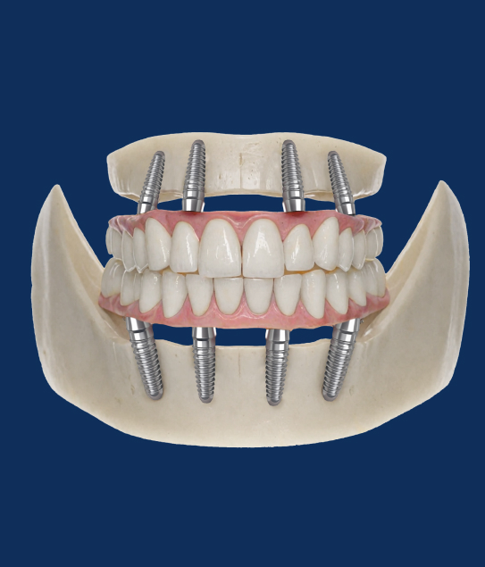 имплантация зубов