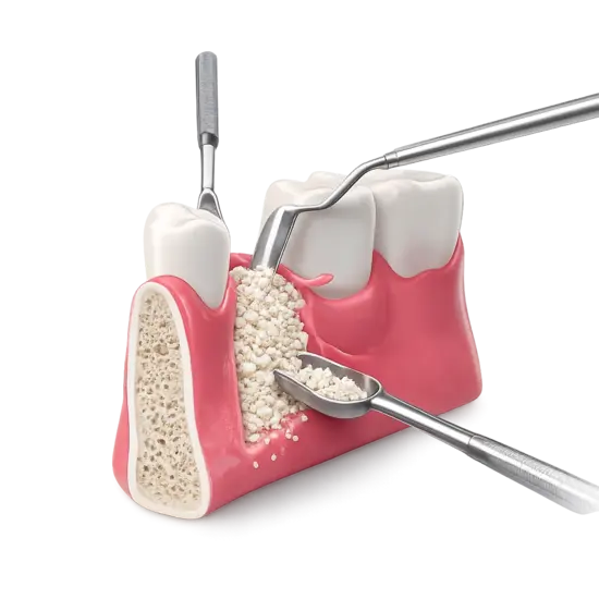 Подсадка костной ткани для гарантированного приживления импланта