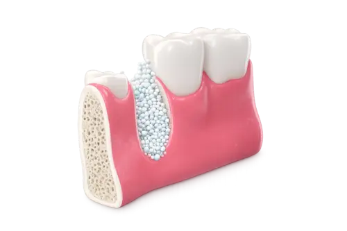 Сертифицированные материалы обеспечивают гарантированное приживление кости