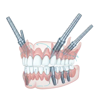 Скуловая имплантация