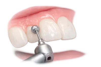 Минимальная обработка зубов