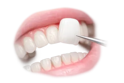 Точная примерка и фиксация