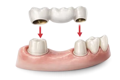 Собственная лаборатория: точные и быстрые протезы