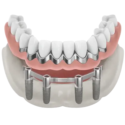 Металлокерамика