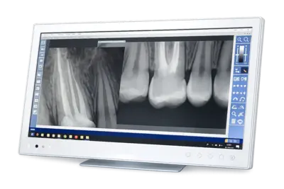 Рентгенография (прицельный снимок)