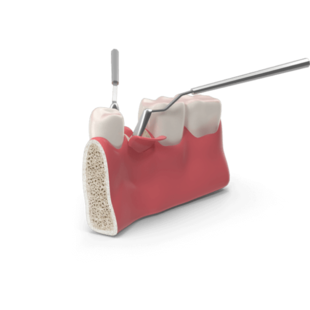 Костная пластика обеспечивает надёжное приживление импланта