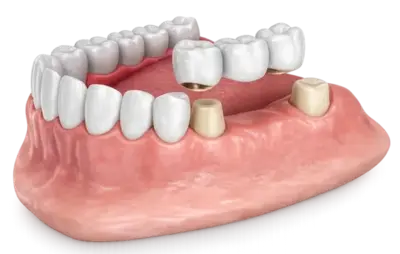 Зубной мост