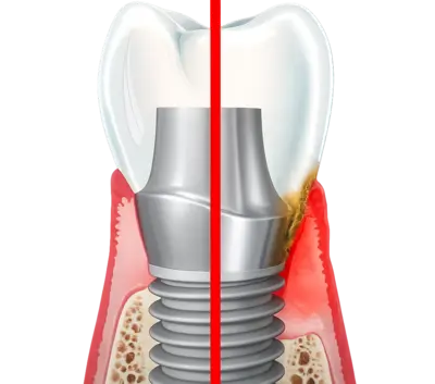 Экспертиза в переимплантите