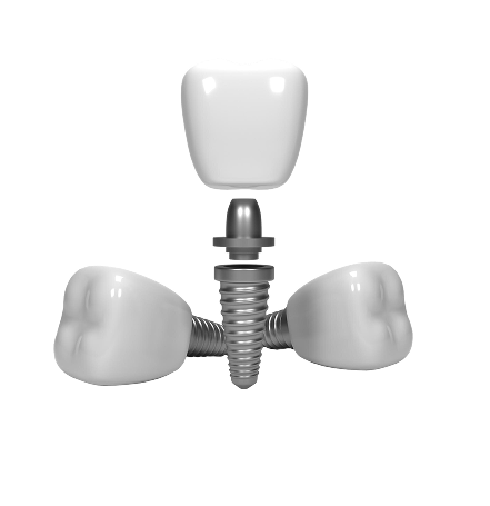 Имплантация зубов Osstem SOI с циркониевой коронкой «под ключ»