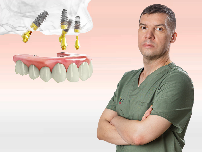 Консультация по имплантации + КТ зубов