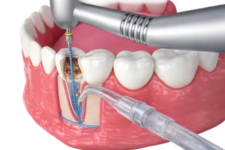 Лечение каналов зуба
