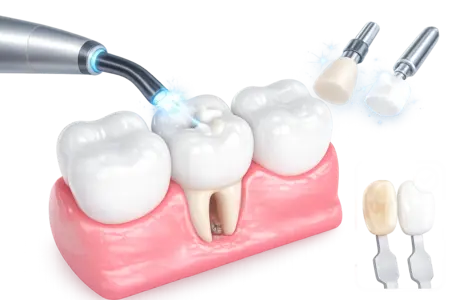 Реставрация зубов