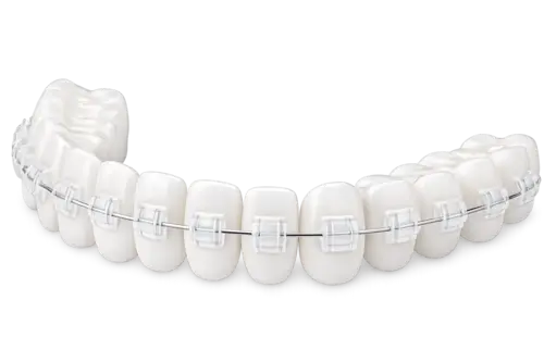 Керамические брекеты