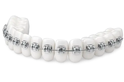 Металлические брекеты