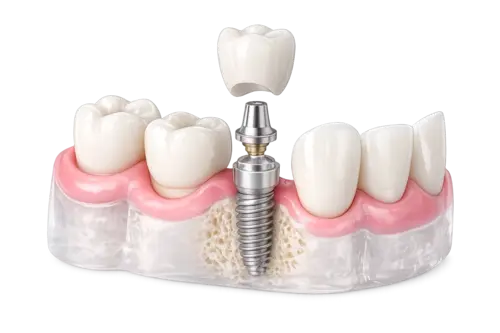 Протезирование на имплантате в КДС Дентал