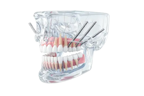 Скуловая имплантация