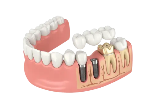 Мостовидные протезы