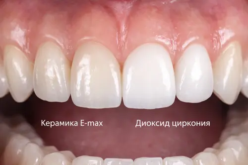 Керамика E-max и диоксид циркония в КДС Дентал