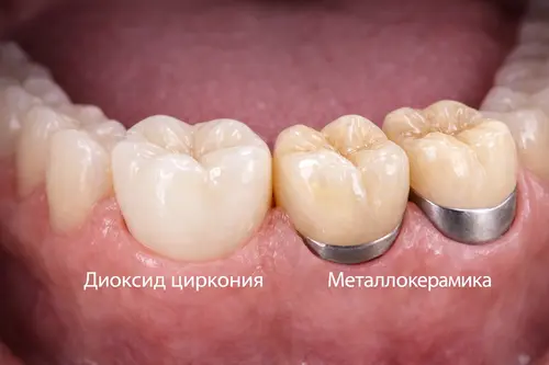 Диоксид циркония и металлокерамика в КДС Дентал