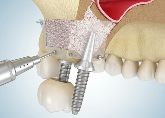 Что такое синус-лифтинг