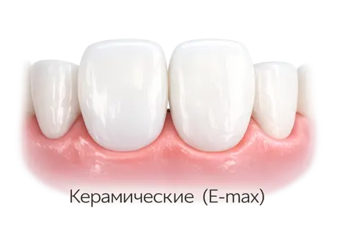 Керамические виниры в Москве