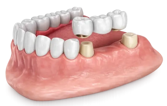 Мостовидные протезы в Москве