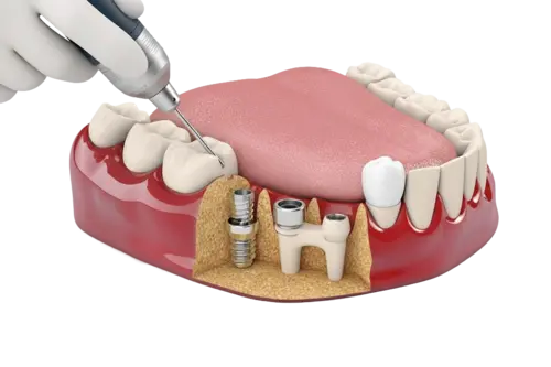 Классическая имплантация
