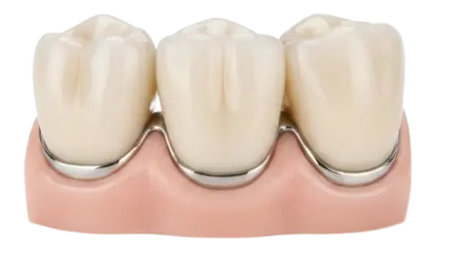 Зубные мосты