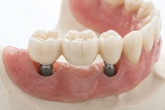 зубной мост на имплантах