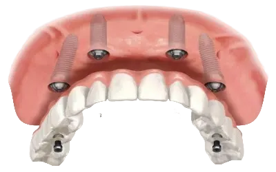 Несъёмное протезирование
