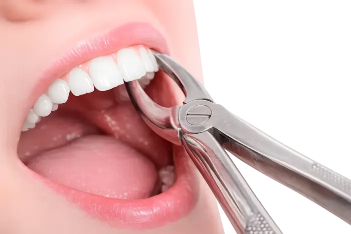 Сложное удаление зуба недорого в Москве