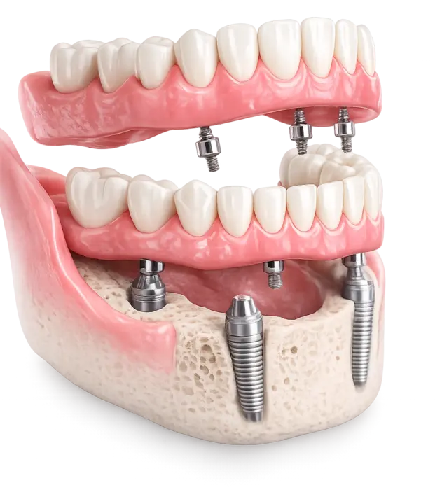 All-on-4 импланты в Москве