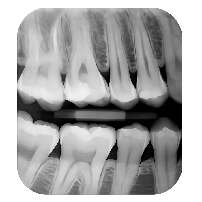 Прикусной рентген-снимок