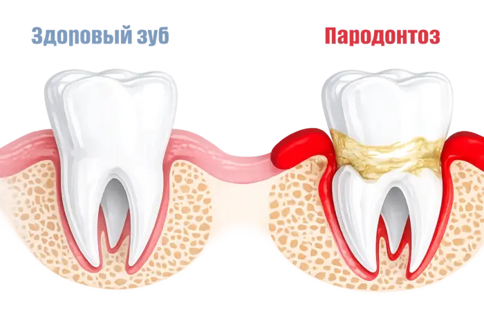 Лечение пародонтоза дёсен по выгодной цене