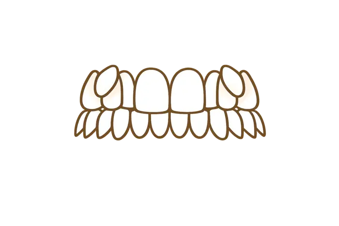 Исправить выступающие клыки с элайнерами в Москве