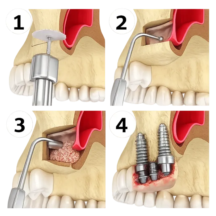 Открытый синус-лифтинг в КДС Дентал