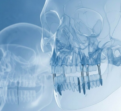 скуловая имплантация