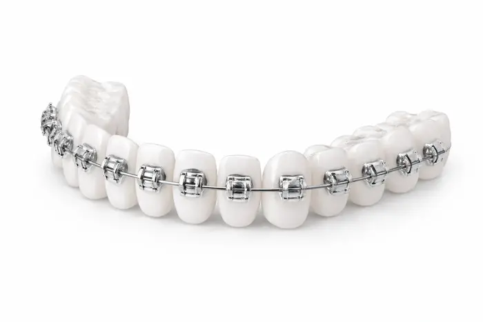 Брекет-система в КДС Дентал в Москве