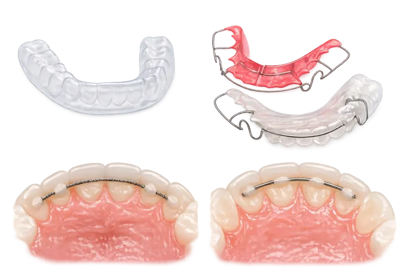 Съёмные и несъёмные ретейнеры в КДС Дентал