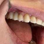 После (миниатюра)